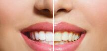 Sizlerinde Rahatlıkla Uygulayacağınız Farklı Diş Beyazlatma Önerileri