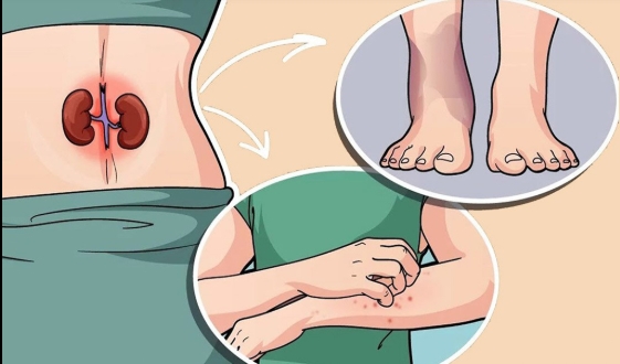 Toplumda sık görülen böbrek hastalıkları çoğu zaman fark edilmeden ilerliyo