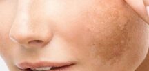 Ünlü Dermatoloji Uzmanın T’arifi İle Ciltteki Lekelerden K’urtulun