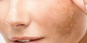 Ünlü Dermatoloji Uzmanın T’arifi İle Ciltteki Lekelerden K’urtulun